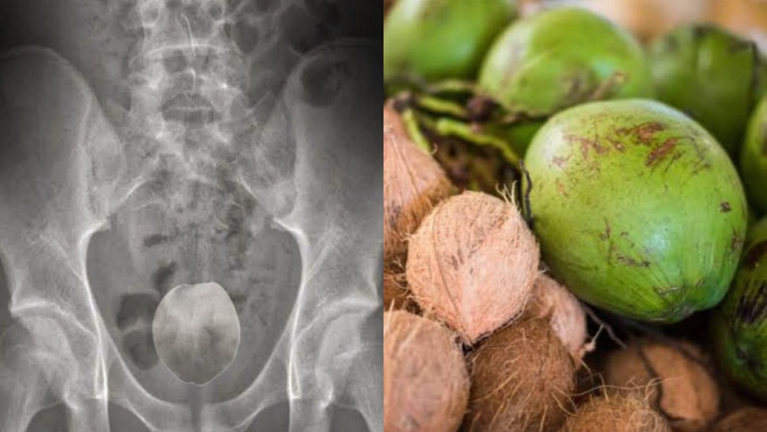 Insólito: Hombre que introdujo un coco por sus partes íntimas terminó hospitalizado
